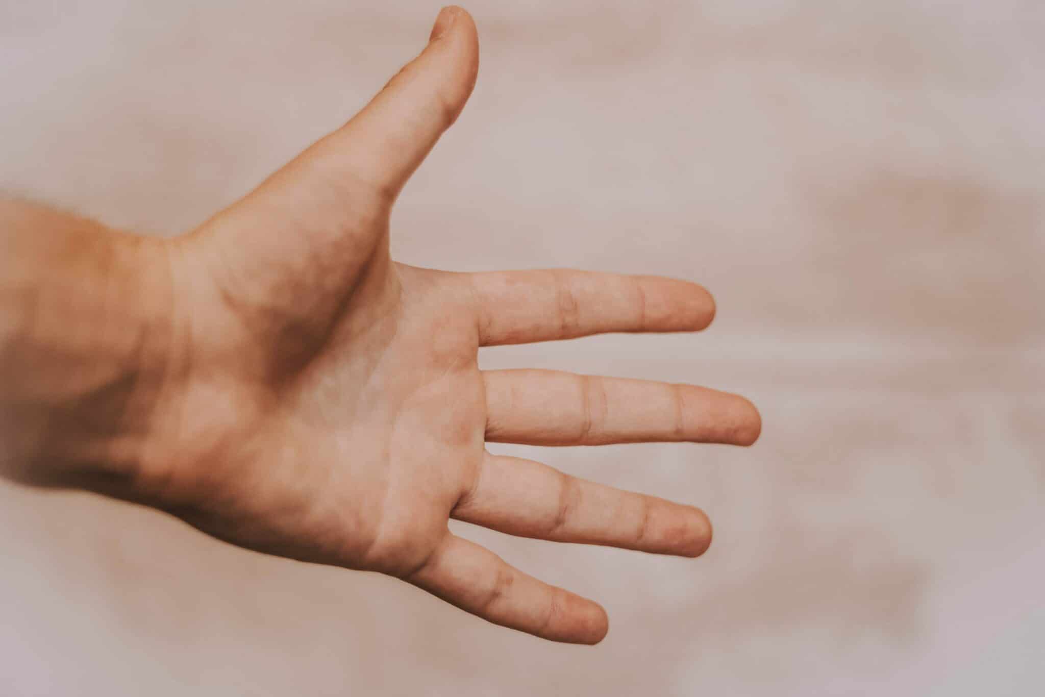 An image of a persons hand with Puffy Hand Syndrome